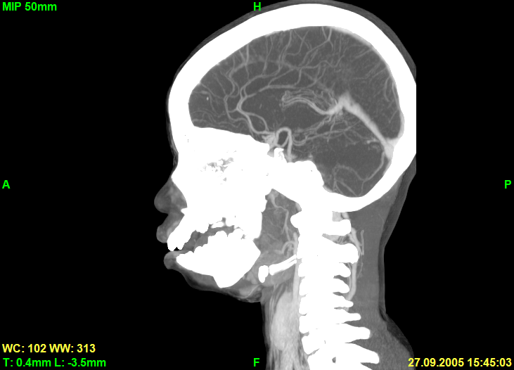 Screenshot of sagittal slice in MIP rendering mode